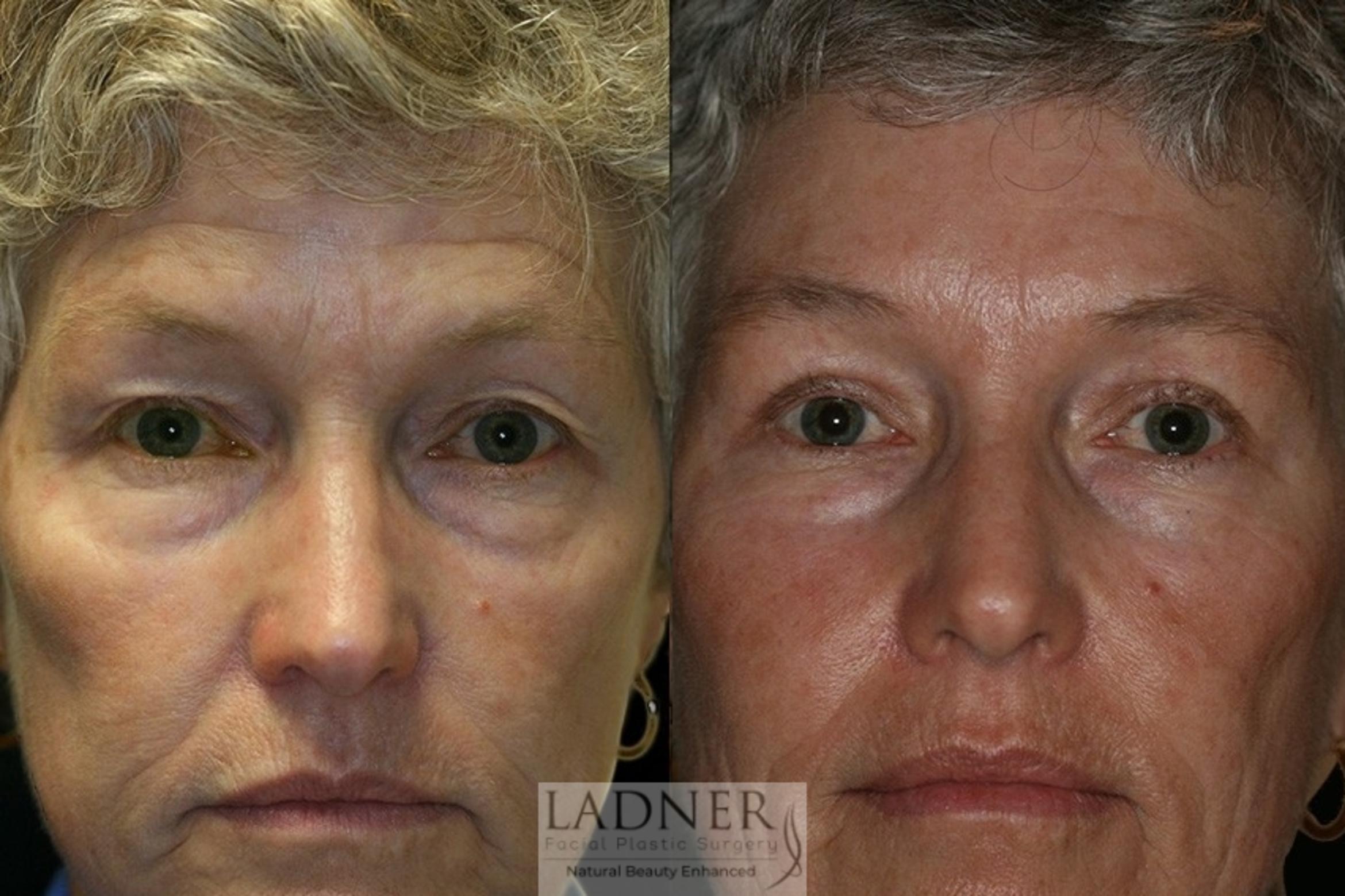 Eyelid Surgery Case 49 Before & After Front | Denver, CO | Ladner Facial Plastic Surgery