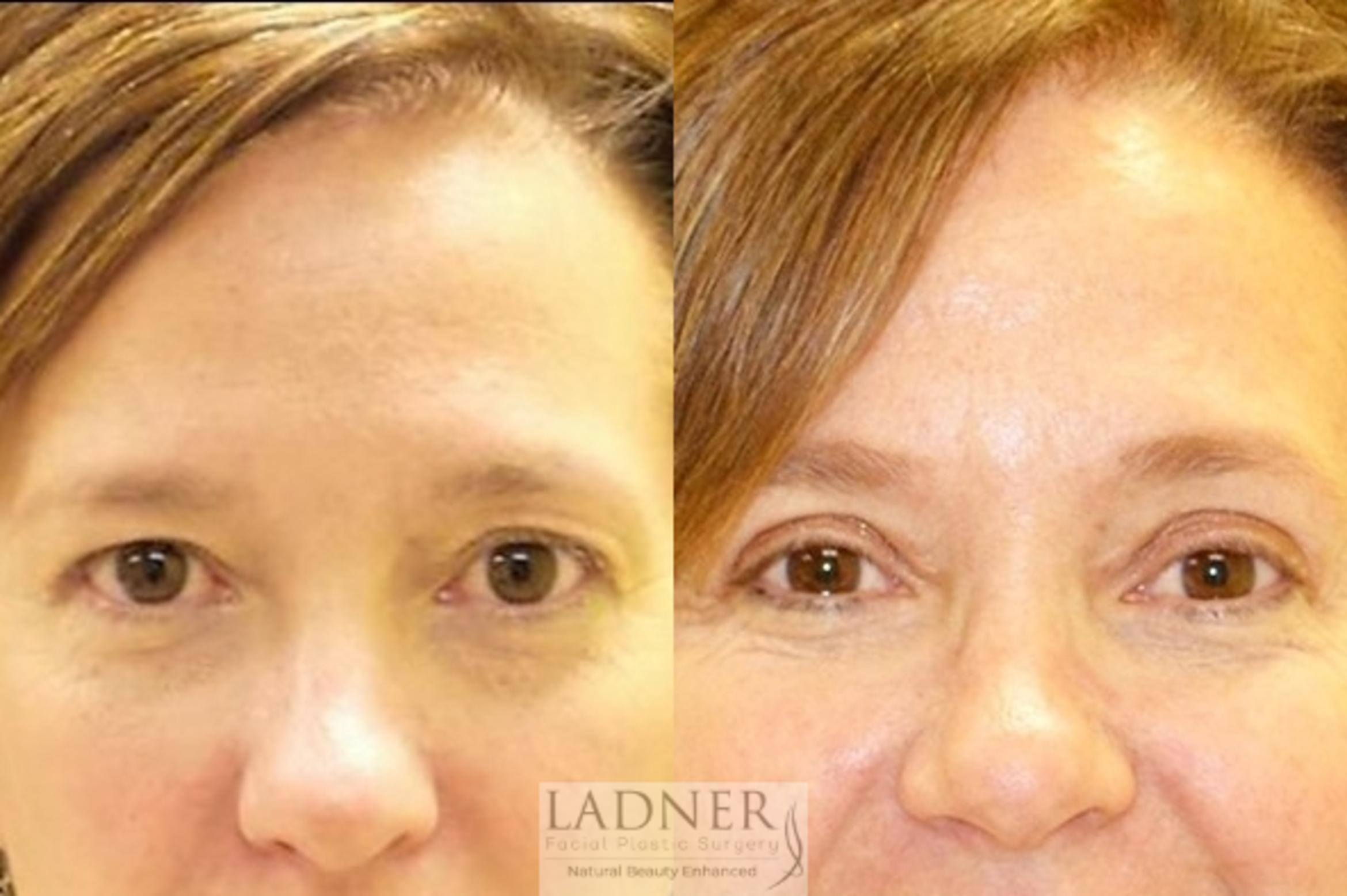 Eyelid Surgery Case 50 Before & After Front | Denver, CO | Ladner Facial Plastic Surgery