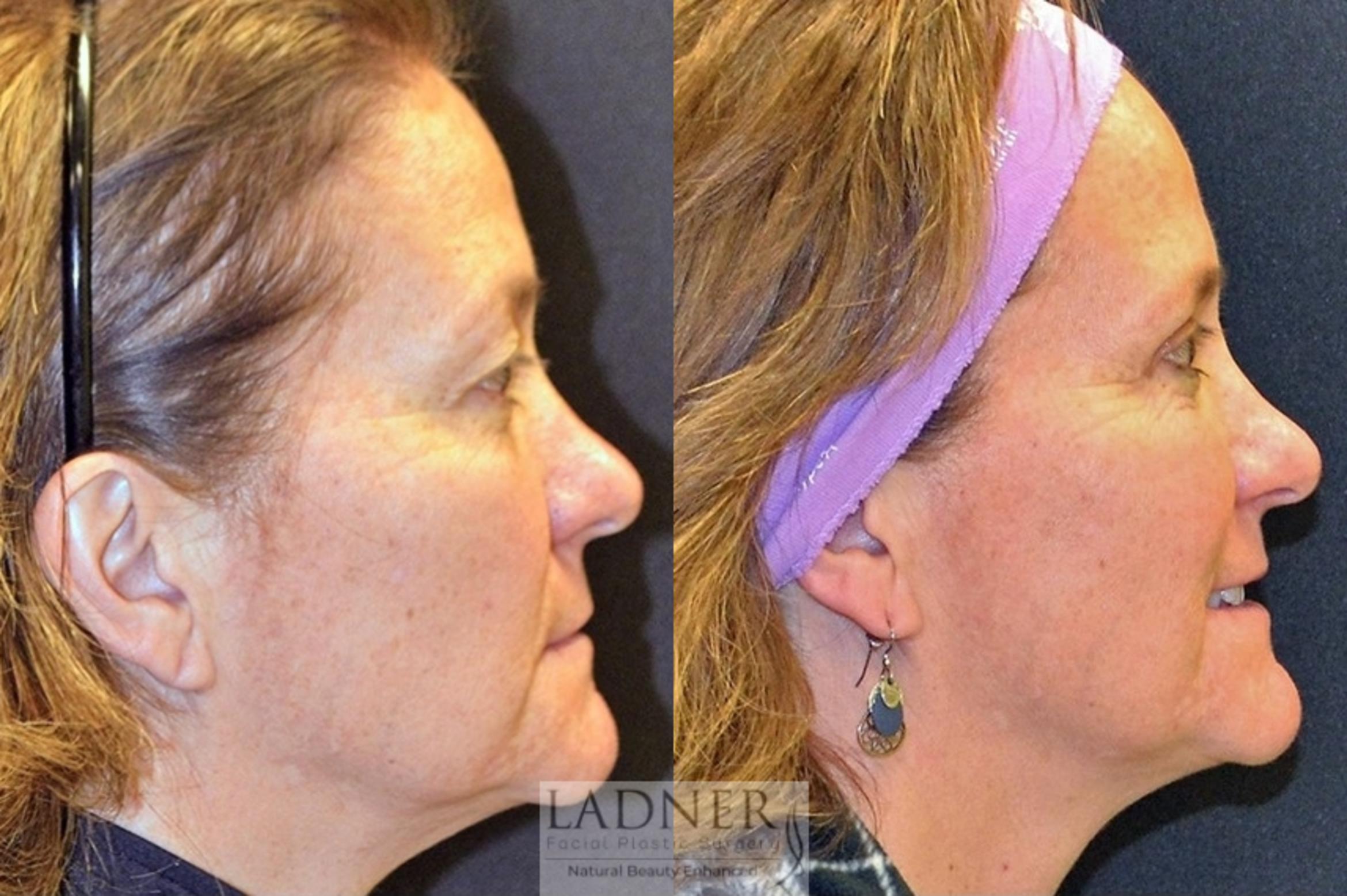 Eyelid Surgery Case 51 Before & After Right Side | Denver, CO | Ladner Facial Plastic Surgery