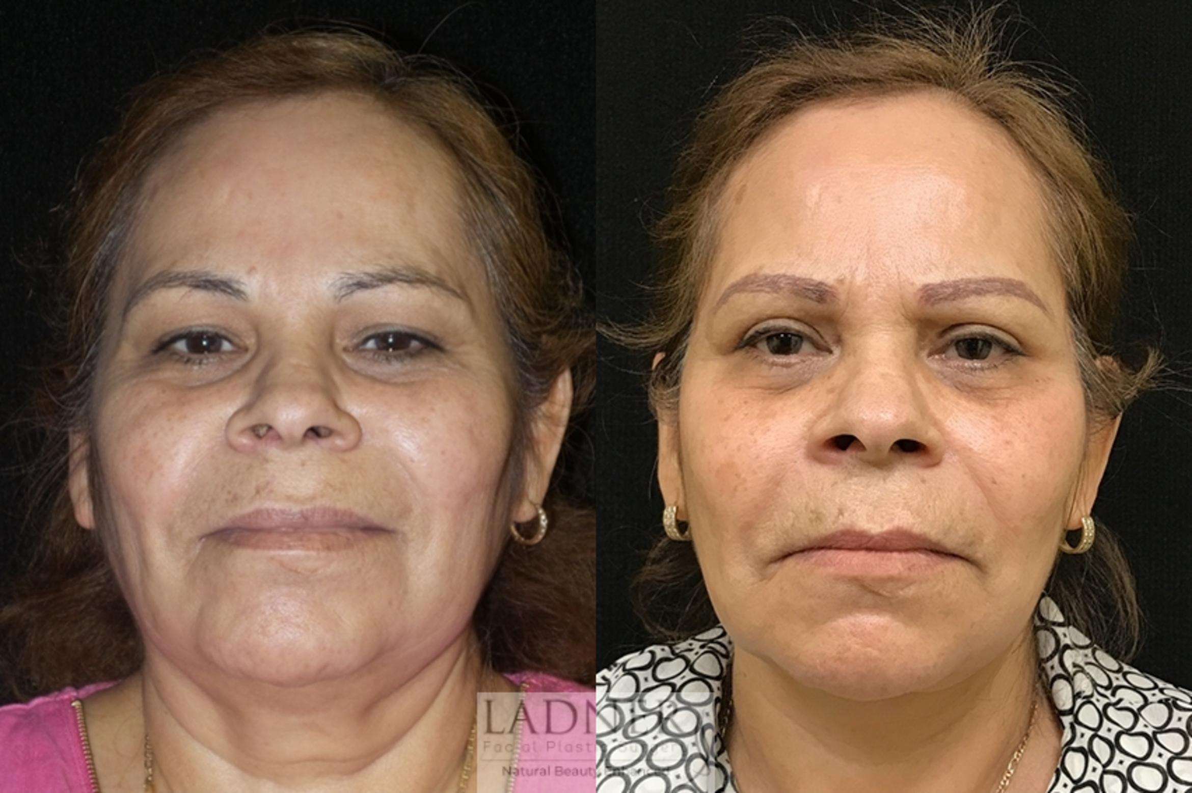 Facelift / Neck Lift Case 53 Before & After Front | Denver, CO | Ladner Facial Plastic Surgery