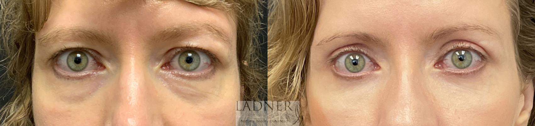 Eyelid Surgery (blepharoplasty) Case 153 Before & After Front | Denver, CO | Ladner Facial Plastic Surgery