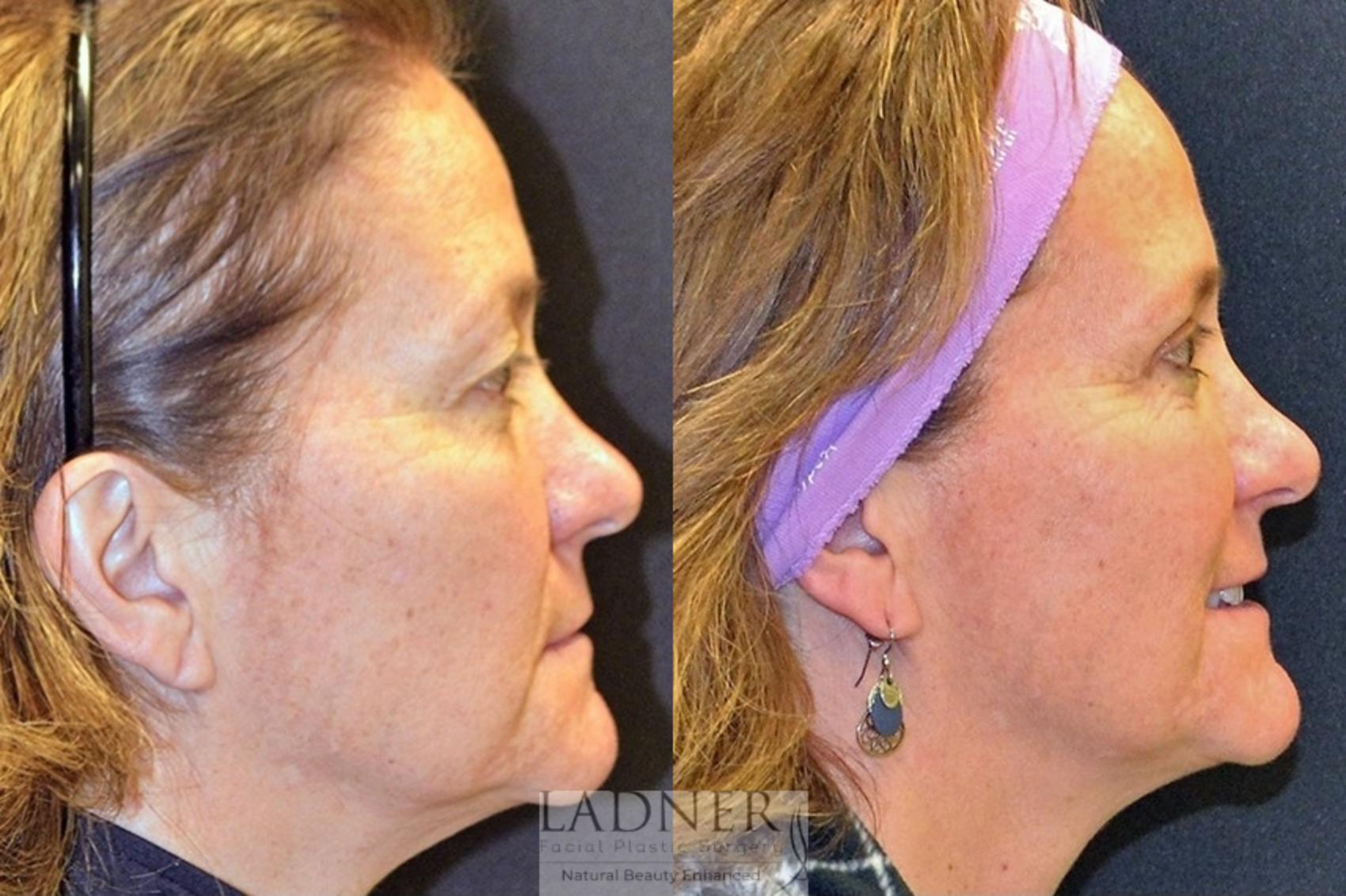 Eyelid Surgery (blepharoplasty) Case 51 Before & After Right Side | Denver, CO | Ladner Facial Plastic Surgery