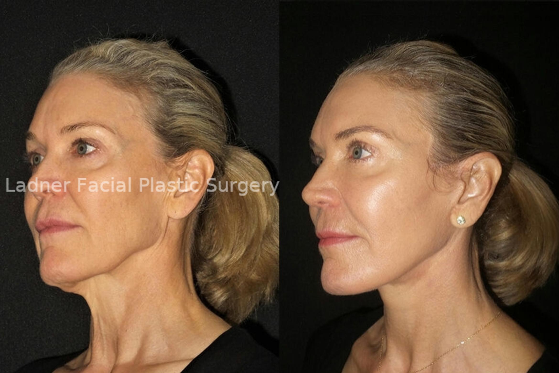 Facelift / Neck Lift Case 26 Before & After Left Oblique | Denver, CO | Ladner Facial Plastic Surgery