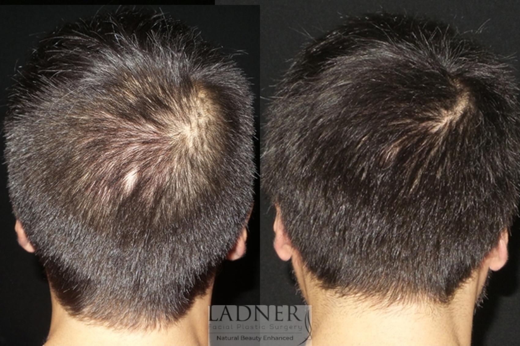 Hair Restoration Case 23 Before & After Back | Denver, CO | Ladner Facial Plastic Surgery