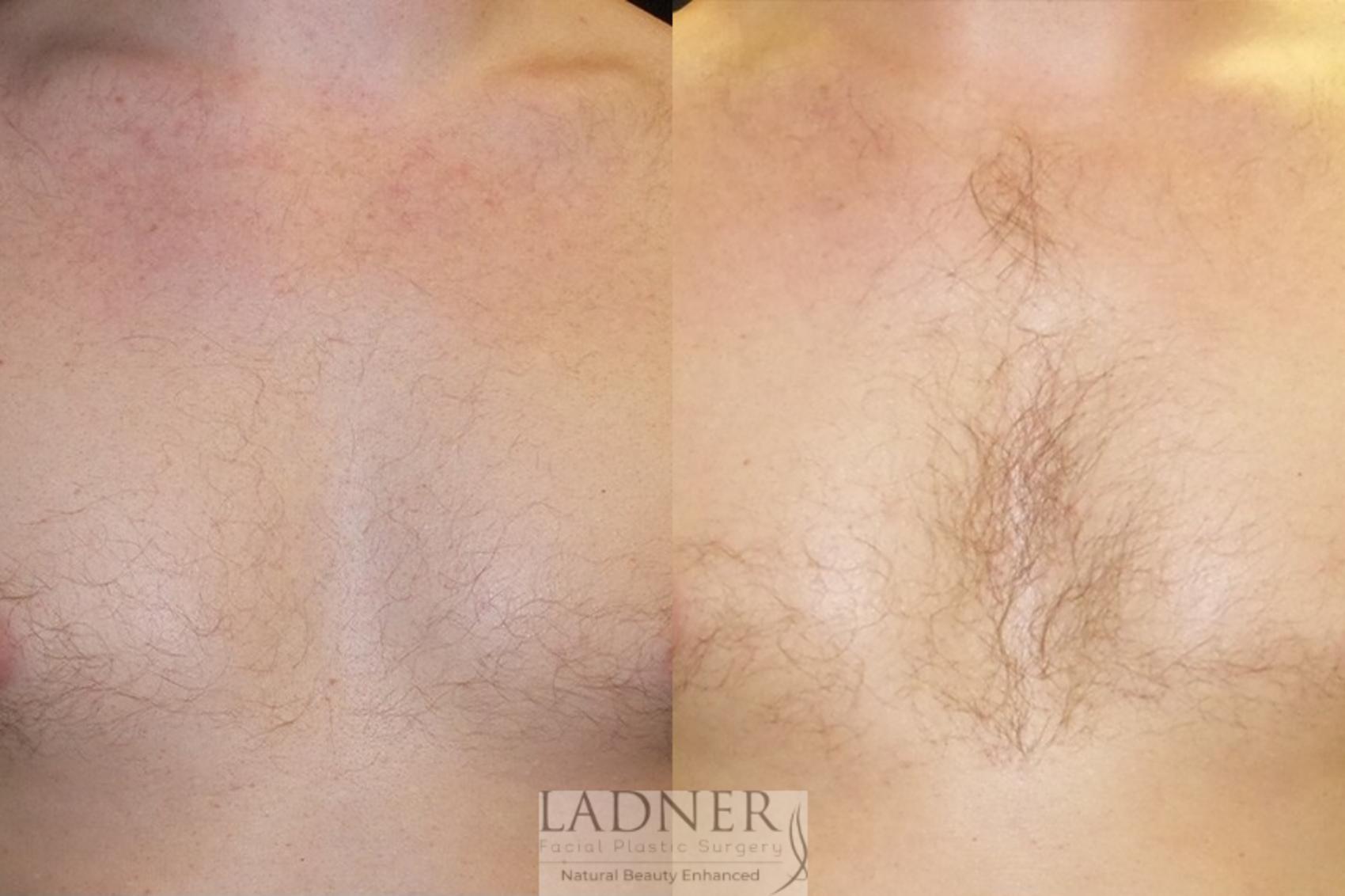 Hair Restoration Case 24 Before & After Front | Denver, CO | Ladner Facial Plastic Surgery