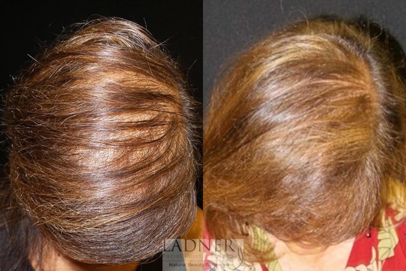 Hair Restoration Case 25 Before & After Top | Denver, CO | Ladner Facial Plastic Surgery
