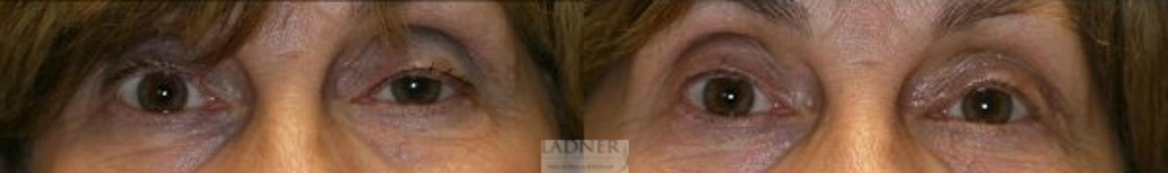 Ptosis Repair Case 58 Before & After Front | Denver, CO | Ladner Facial Plastic Surgery