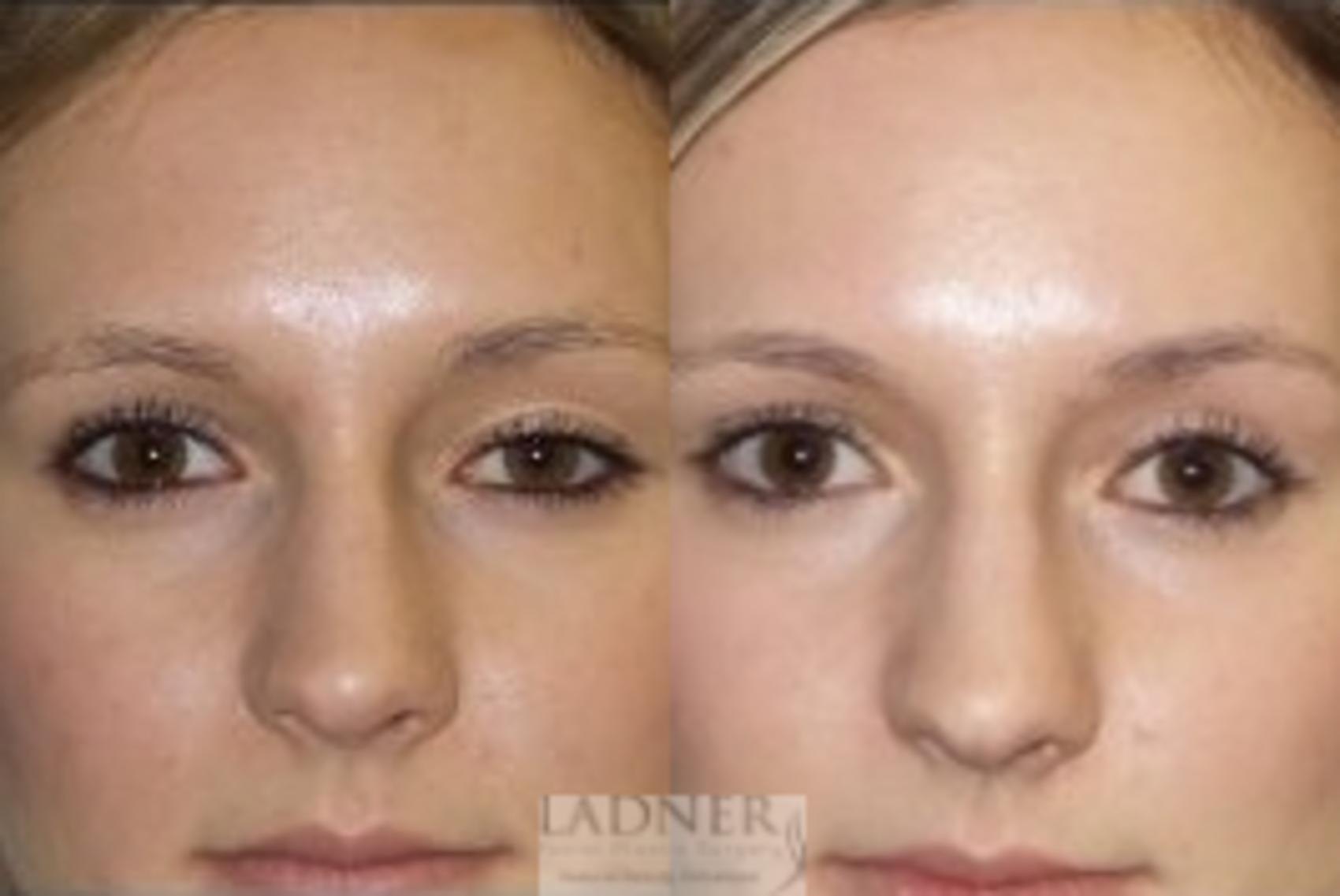 Ptosis Repair Case 59 Before & After Front | Denver, CO | Ladner Facial Plastic Surgery