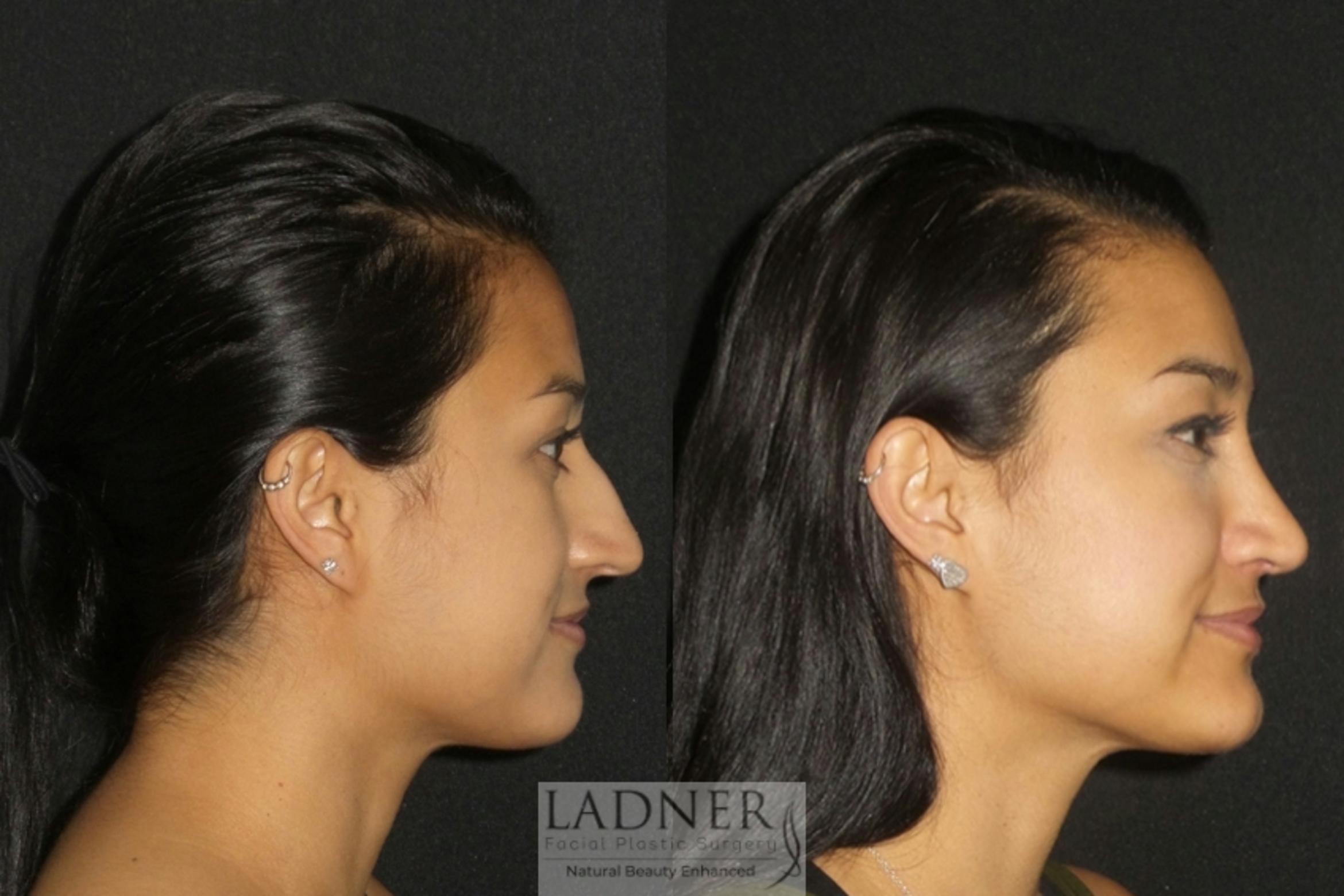 Rhinoplasty Case 1 Before & After Right Side | Denver, CO | Ladner Facial Plastic Surgery