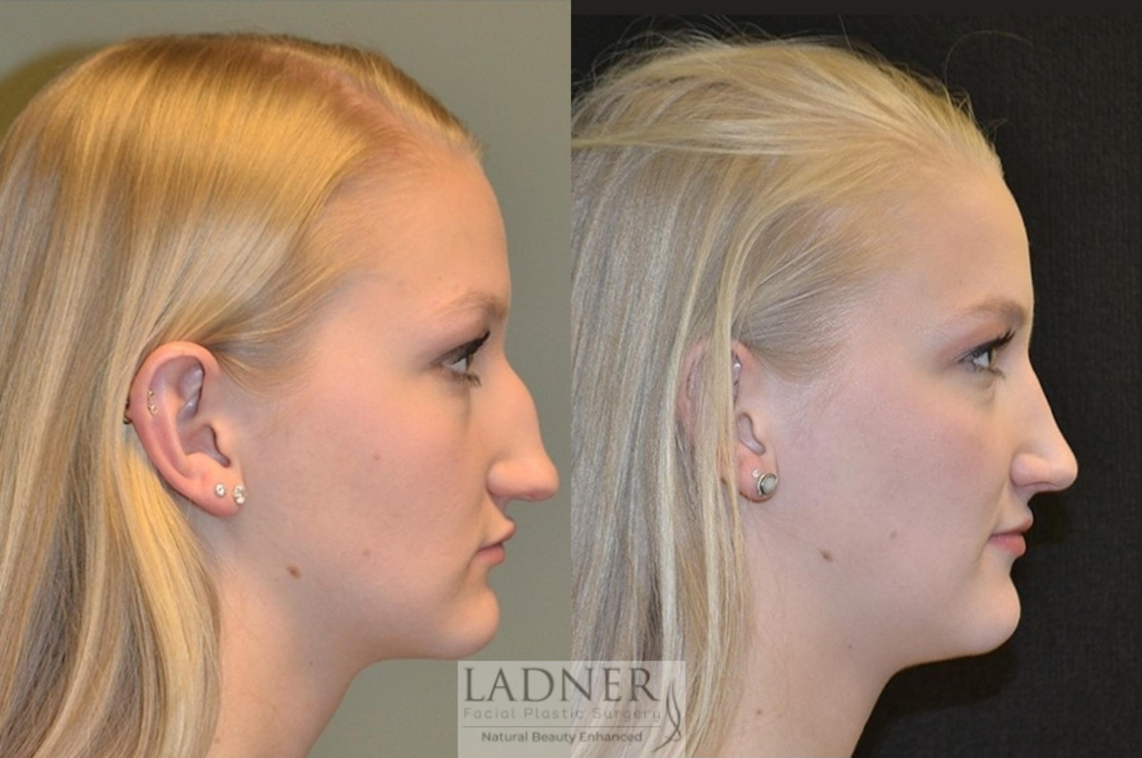 Rhinoplasty Case 14 Before & After Right Side | Denver, CO | Ladner Facial Plastic Surgery