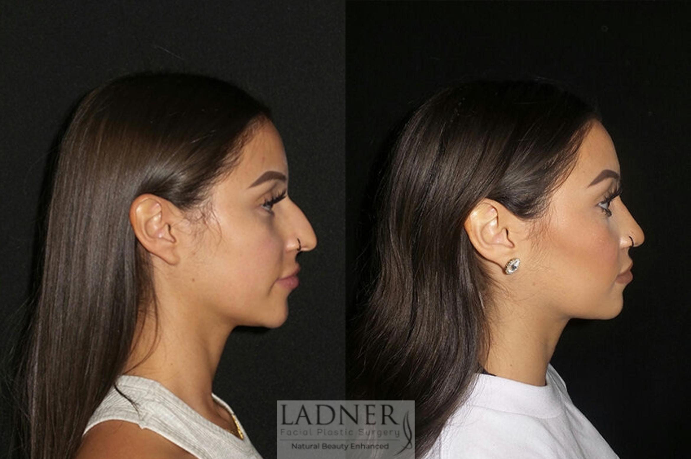 Rhinoplasty Case 3 Before & After Right Side | Denver, CO | Ladner Facial Plastic Surgery