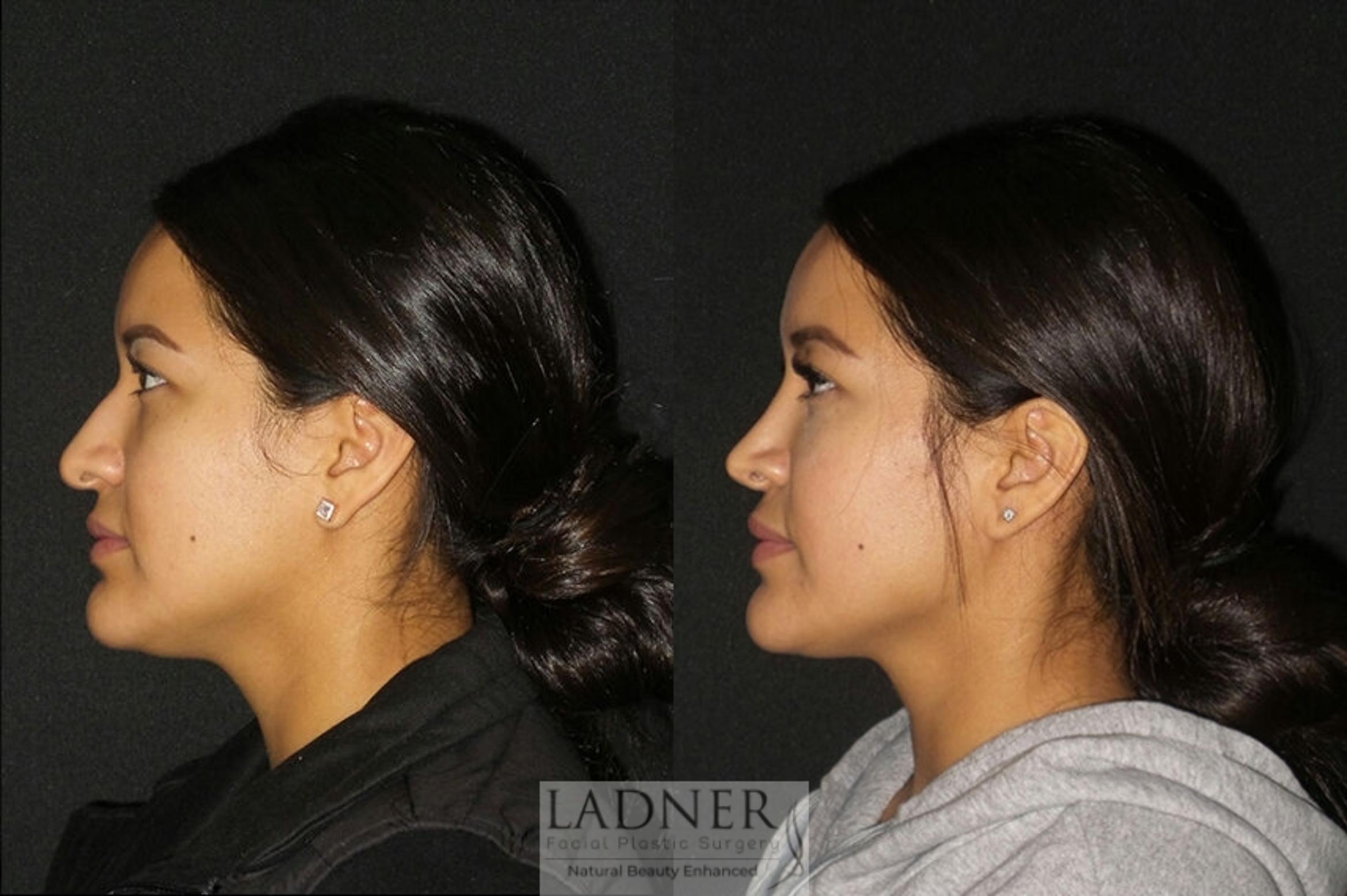 Rhinoplasty Case 6 Before & After Left Side | Denver, CO | Ladner Facial Plastic Surgery