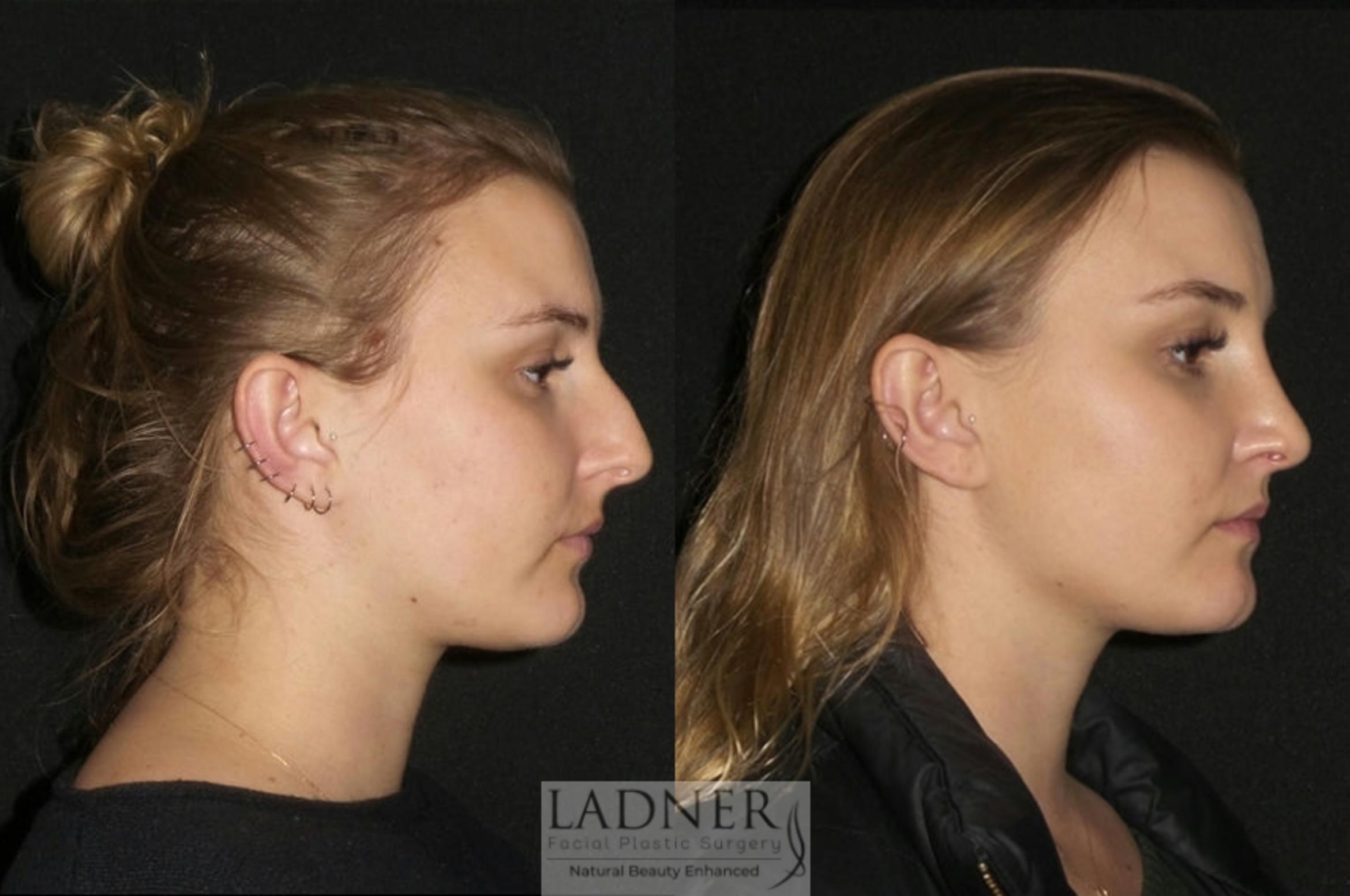 Rhinoplasty Case 7 Before & After Right Side | Denver, CO | Ladner Facial Plastic Surgery