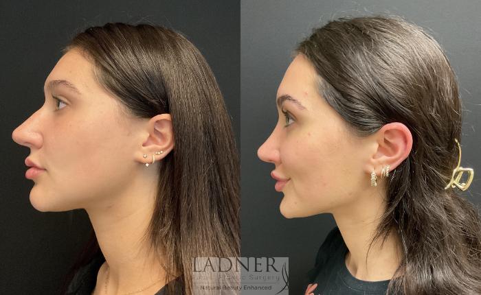Rhinoplasty (Nose job) Case 168 Before & After Left Side | Denver, CO | Ladner Facial Plastic Surgery