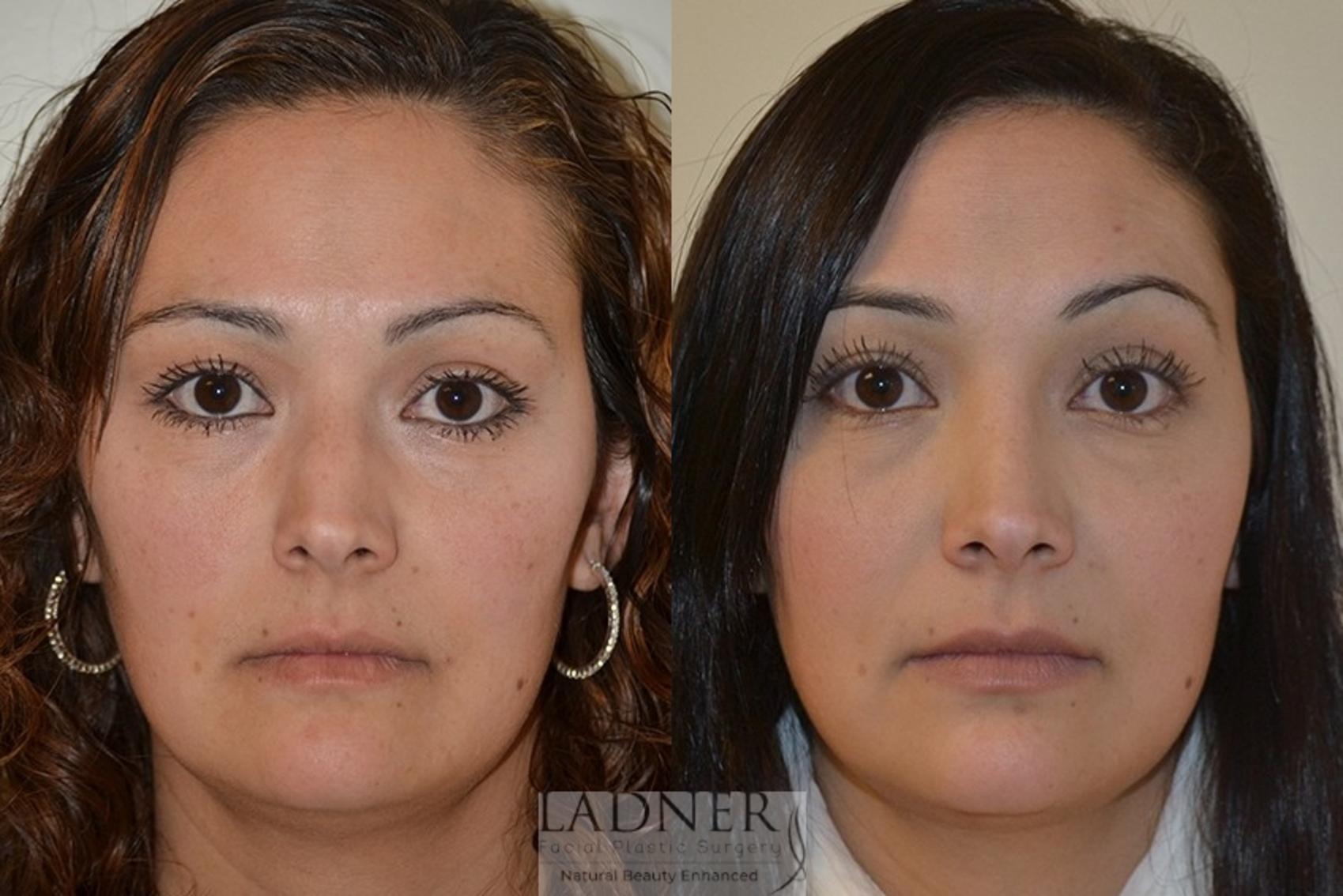 Rhinoplasty Nose Job Before And After Pictures Case Denver CO Ladner Facial Plastic