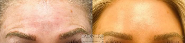 BOTOX® Cosmetic Case 161 Before & After Front | Denver, CO | Ladner Facial Plastic Surgery