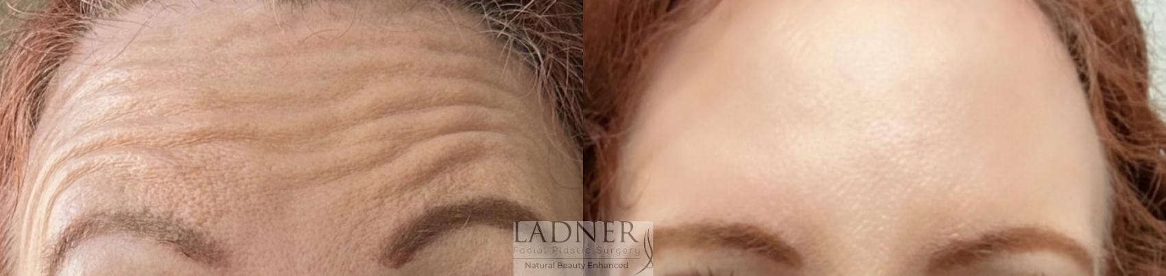BOTOX® Cosmetic Case 162 Before & After Front | Denver, CO | Ladner Facial Plastic Surgery