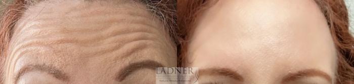 BOTOX® Cosmetic Case 162 Before & After Front | Denver, CO | Ladner Facial Plastic Surgery