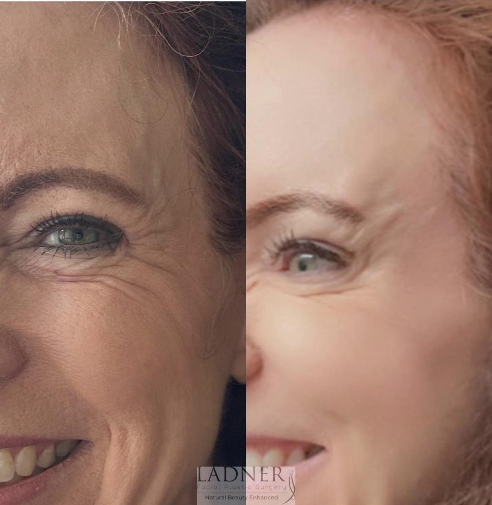 BOTOX® Cosmetic Case 162 Before & After Left Side | Denver, CO | Ladner Facial Plastic Surgery