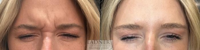 BOTOX® Cosmetic Case 211 Before & After Front | Denver, CO | Ladner Facial Plastic Surgery
