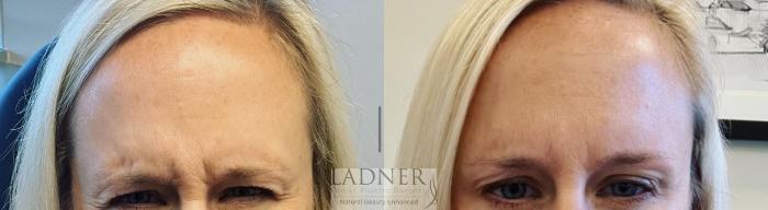 BOTOX® Cosmetic Case 212 Before & After Front | Denver, CO | Ladner Facial Plastic Surgery