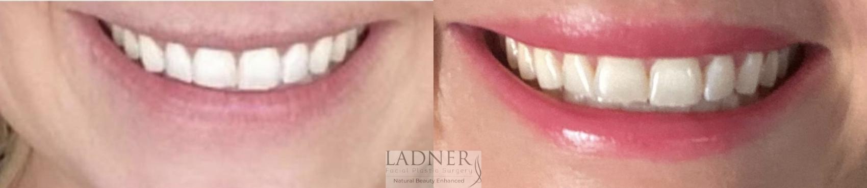 BOTOX® Cosmetic Case 215 Before & After Front | Denver, CO | Ladner Facial Plastic Surgery