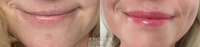 BOTOX® Cosmetic Case 215 Before & After Left Side | Denver, CO | Ladner Facial Plastic Surgery
