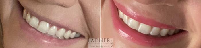 BOTOX® Cosmetic Case 215 Before & After Right Side | Denver, CO | Ladner Facial Plastic Surgery
