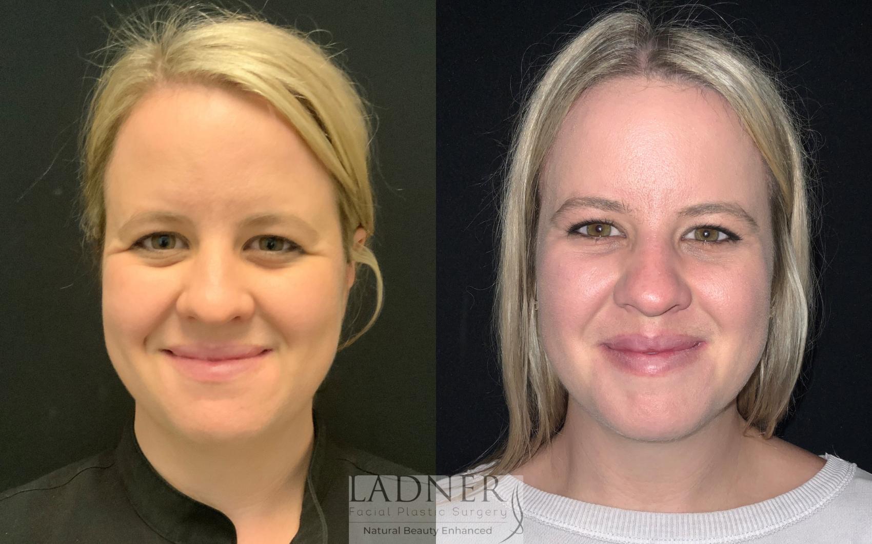 Brow Lift Forehead Lift Before And After Photo Gallery Denver Co Ladner Facial Plastic 