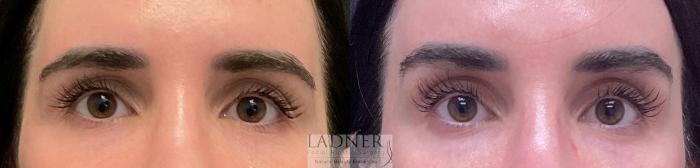 Brow Lift / Forehead Lift Case 197 Before & After Front | Denver, CO | Ladner Facial Plastic Surgery