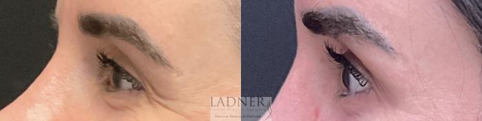 Brow Lift / Forehead Lift Case 197 Before & After Left Side | Denver, CO | Ladner Facial Plastic Surgery