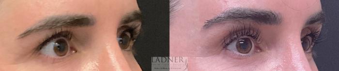 Brow Lift / Forehead Lift Case 197 Before & After Right Oblique | Denver, CO | Ladner Facial Plastic Surgery