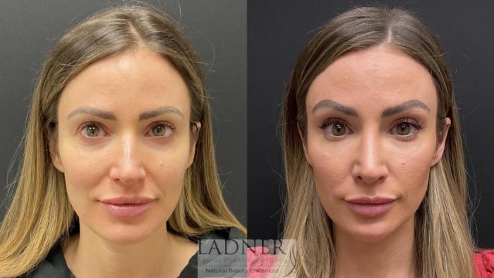 Brow Lift / Forehead Lift Case 222 Before & After Front | Denver, CO | Ladner Facial Plastic Surgery