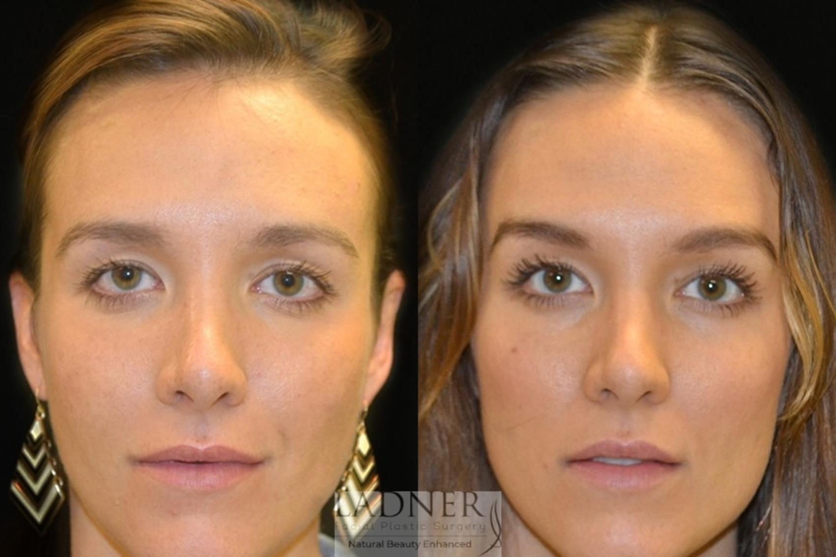 Brow Lift / Forehead Lift Case 56 Before & After Front | Denver, CO | Ladner Facial Plastic Surgery
