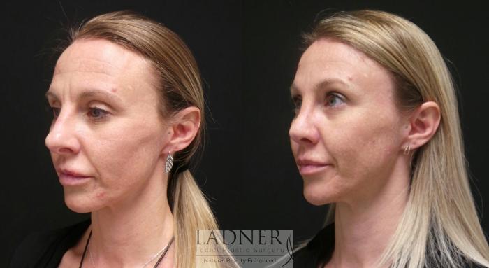 Brow Lift / Forehead Lift Case 89 Before & After Left Oblique | Denver, CO | Ladner Facial Plastic Surgery