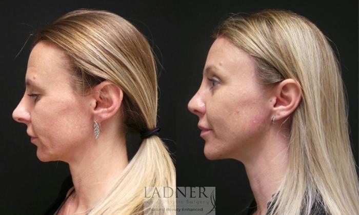 Brow Lift / Forehead Lift Case 89 Before & After Left Side | Denver, CO | Ladner Facial Plastic Surgery