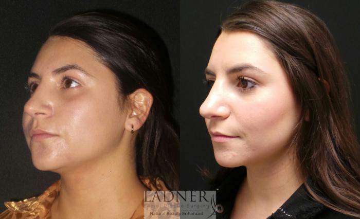 Buccal Fat Removal Case 160 Before & After Left Oblique | Denver, CO | Ladner Facial Plastic Surgery