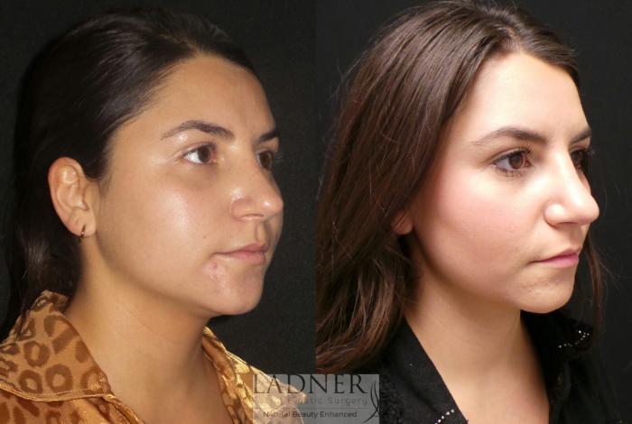 Buccal Fat Removal Case 160 Before & After Right Oblique | Denver, CO | Ladner Facial Plastic Surgery