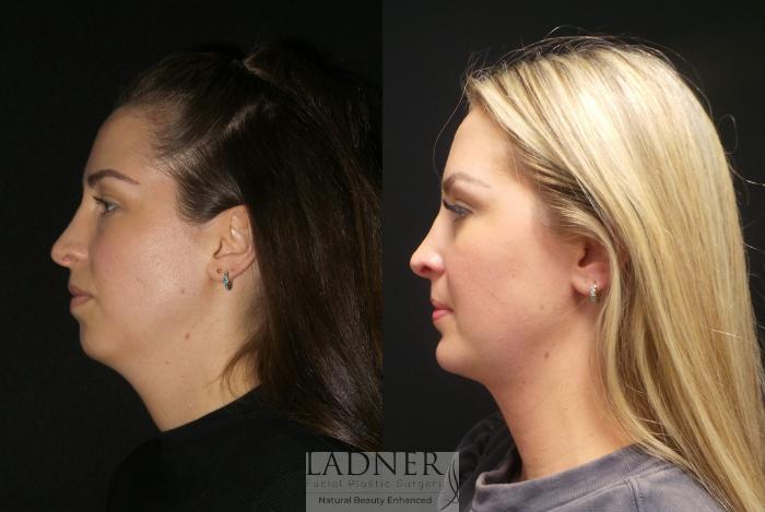 Liposuction for Back Fat in Englewood - Top Plastic Surgeon New