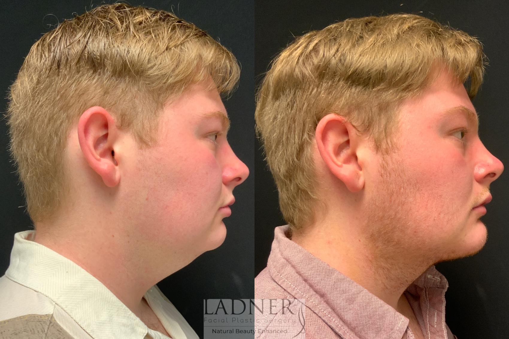 Before: Chin Augmentation & Submental Liposuction