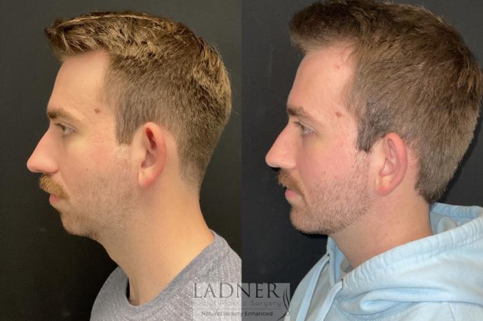 Before: Chin Augmentation/Implant