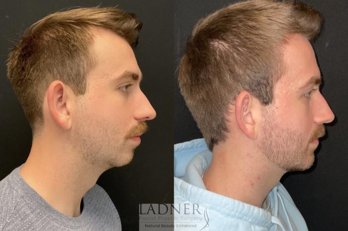 Before: Chin Augmentation/Implant