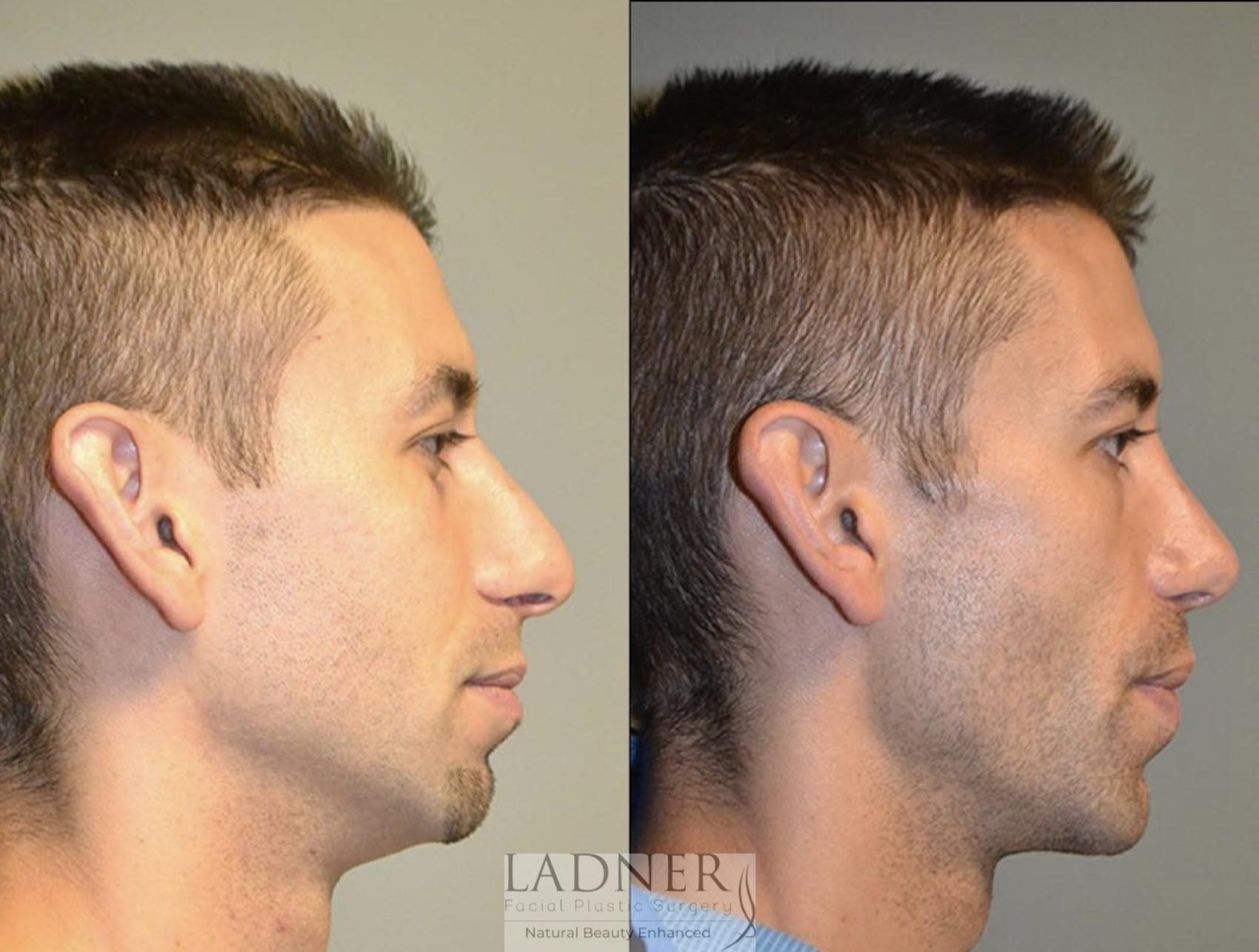 Rhinoplasty (Nose job) Case 155 Before & After Right Side | Denver, CO | Ladner Facial Plastic Surgery