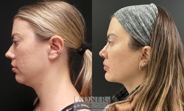 Chin Augmentation Case 156 Before & After Left Side | Denver, CO | Ladner Facial Plastic Surgery