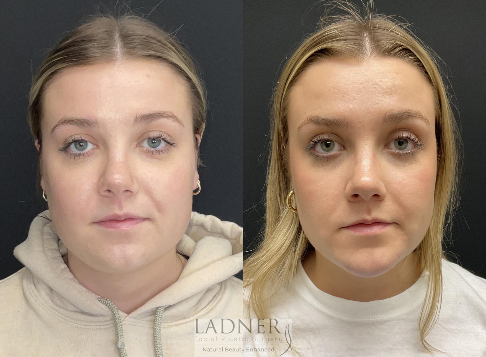 Chin Augmentation Case 188 Before & After Front | Denver, CO | Ladner Facial Plastic Surgery