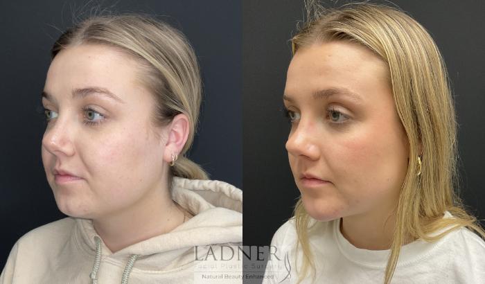 Submental Liposuction Case 188 Before & After Left Oblique | Denver, CO | Ladner Facial Plastic Surgery