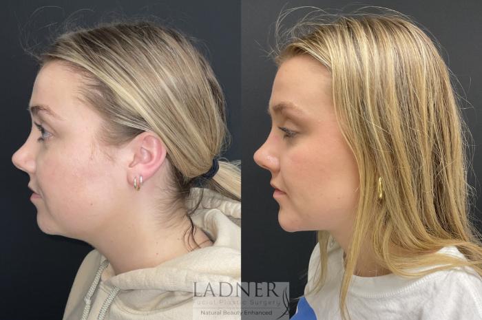 Chin Augmentation Case 188 Before & After Left Side | Denver, CO | Ladner Facial Plastic Surgery