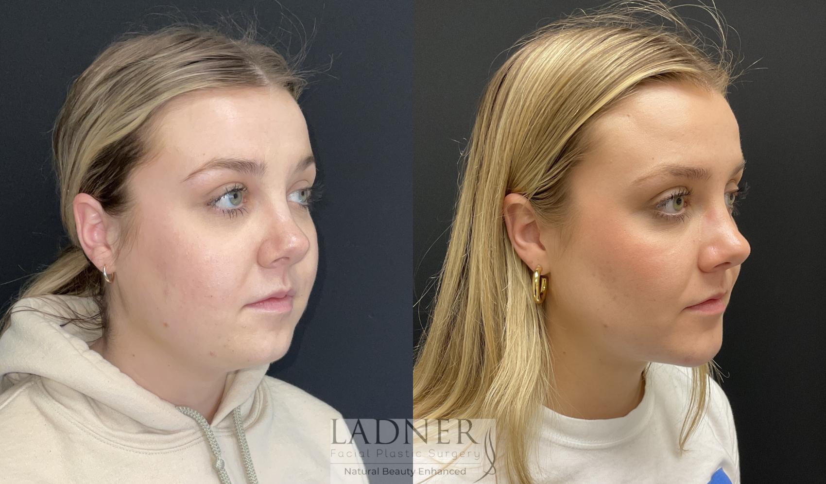 Chin Augmentation Case 188 Before & After Right Oblique | Denver, CO | Ladner Facial Plastic Surgery