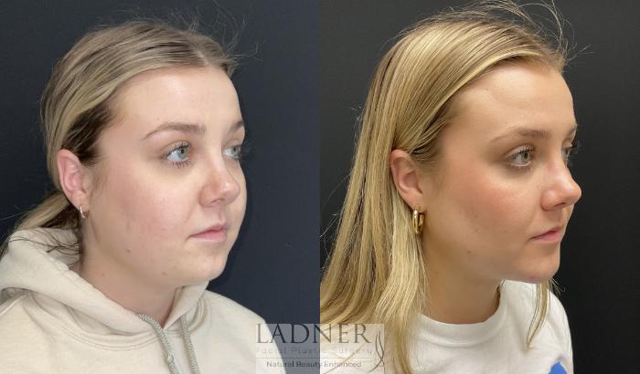 Submental Liposuction Case 188 Before & After Right Oblique | Denver, CO | Ladner Facial Plastic Surgery