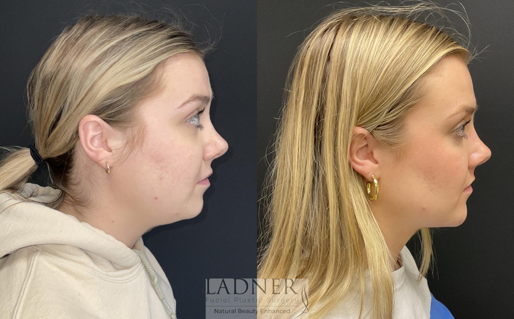 Chin Augmentation Case 188 Before & After Right Side | Denver, CO | Ladner Facial Plastic Surgery